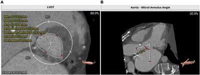 Case report: Transapical transcatheter double valve-in-valve replacement of degenerated aortic and mitral bioprosthetic valves with limited radiopaque landmarks